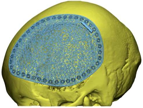 第三类医疗器械注册证获颁！祝贺张鹏教授联合团队